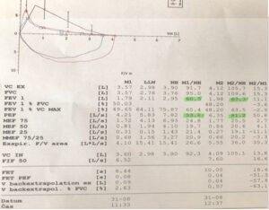 Obrázek 1 Vstupní spirometrické vyšetření s pozitivním bronchodilatačním testem (rok 2005). 
